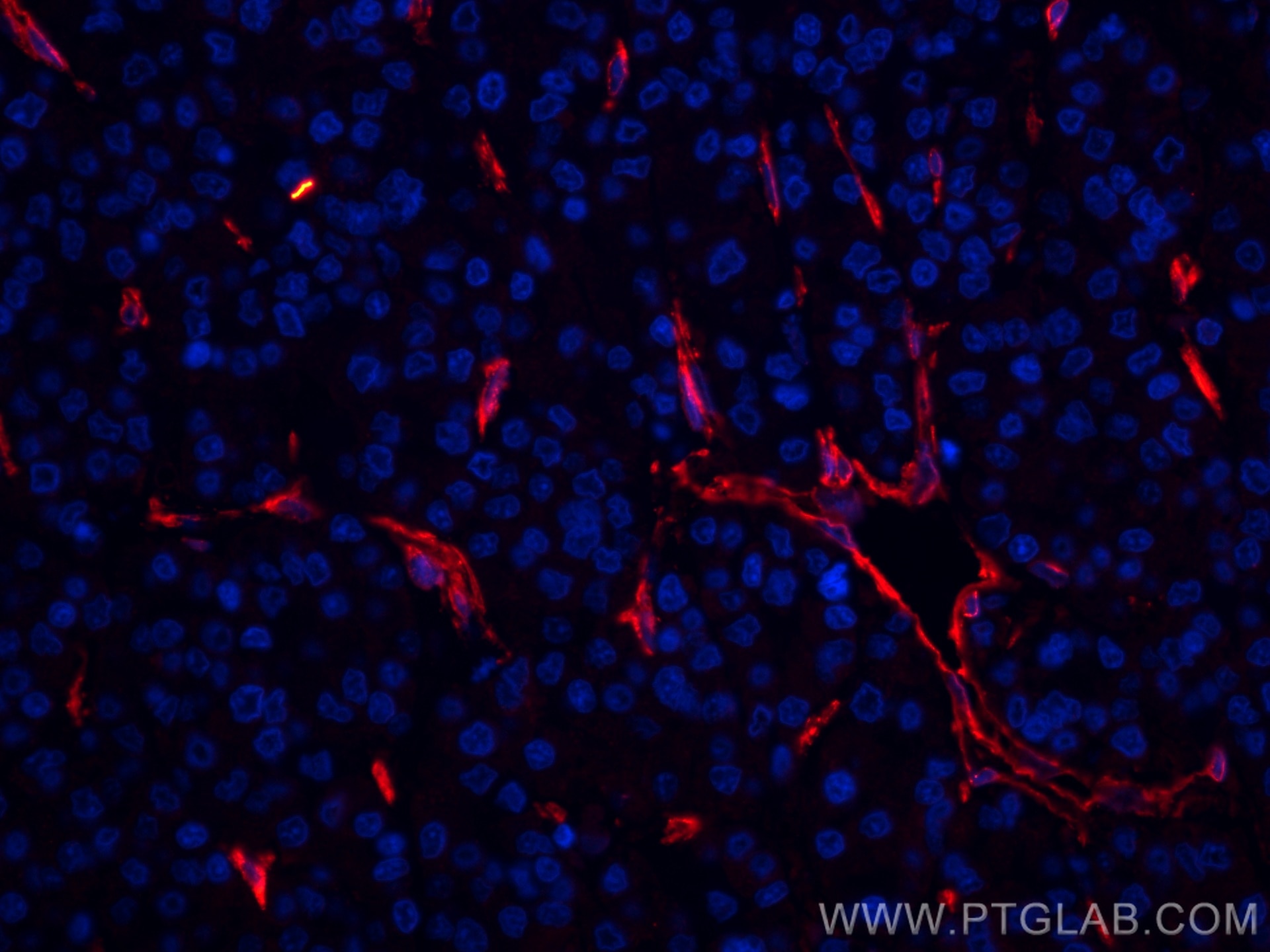 Immunofluorescence (IF) / fluorescent staining of human liver cancer tissue using CoraLite®594-conjugated Caveolin-1 Monoclonal anti (CL594-66067)