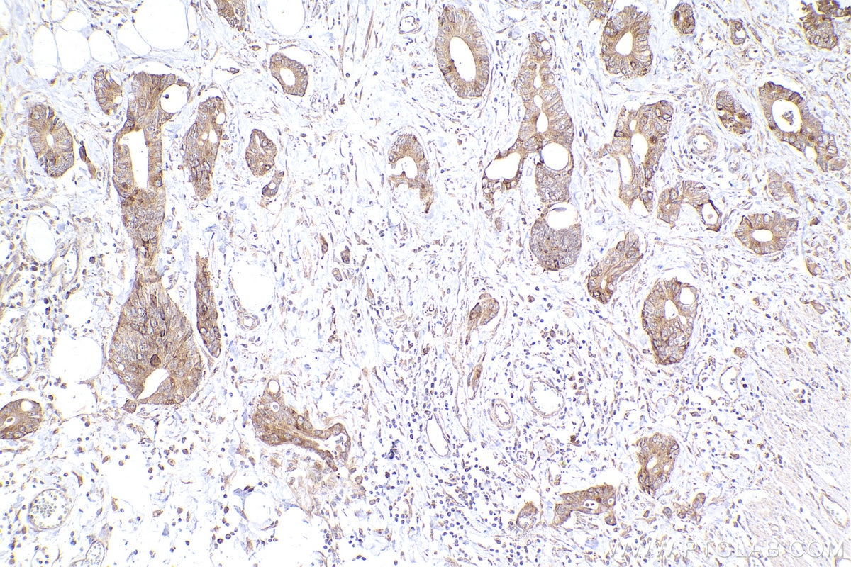 IHC staining of human rectal cancer using 26457-1-AP Immunohistochemistry (IHC) staining of human rectal cancer tissue using Ch-TOG Polyclonal antibody (26457-1-AP)