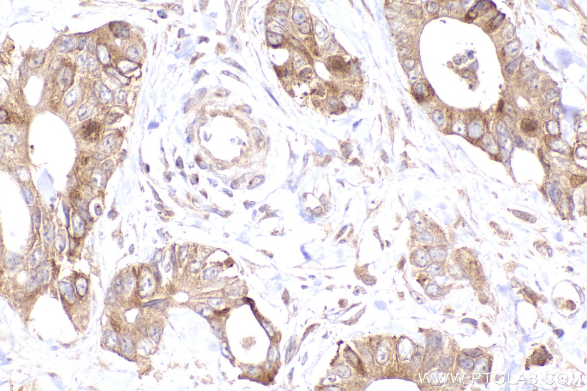 IHC staining of human rectal cancer using 26457-1-AP Immunohistochemistry (IHC) staining of human rectal cancer tissue using Ch-TOG Polyclonal antibody (26457-1-AP)