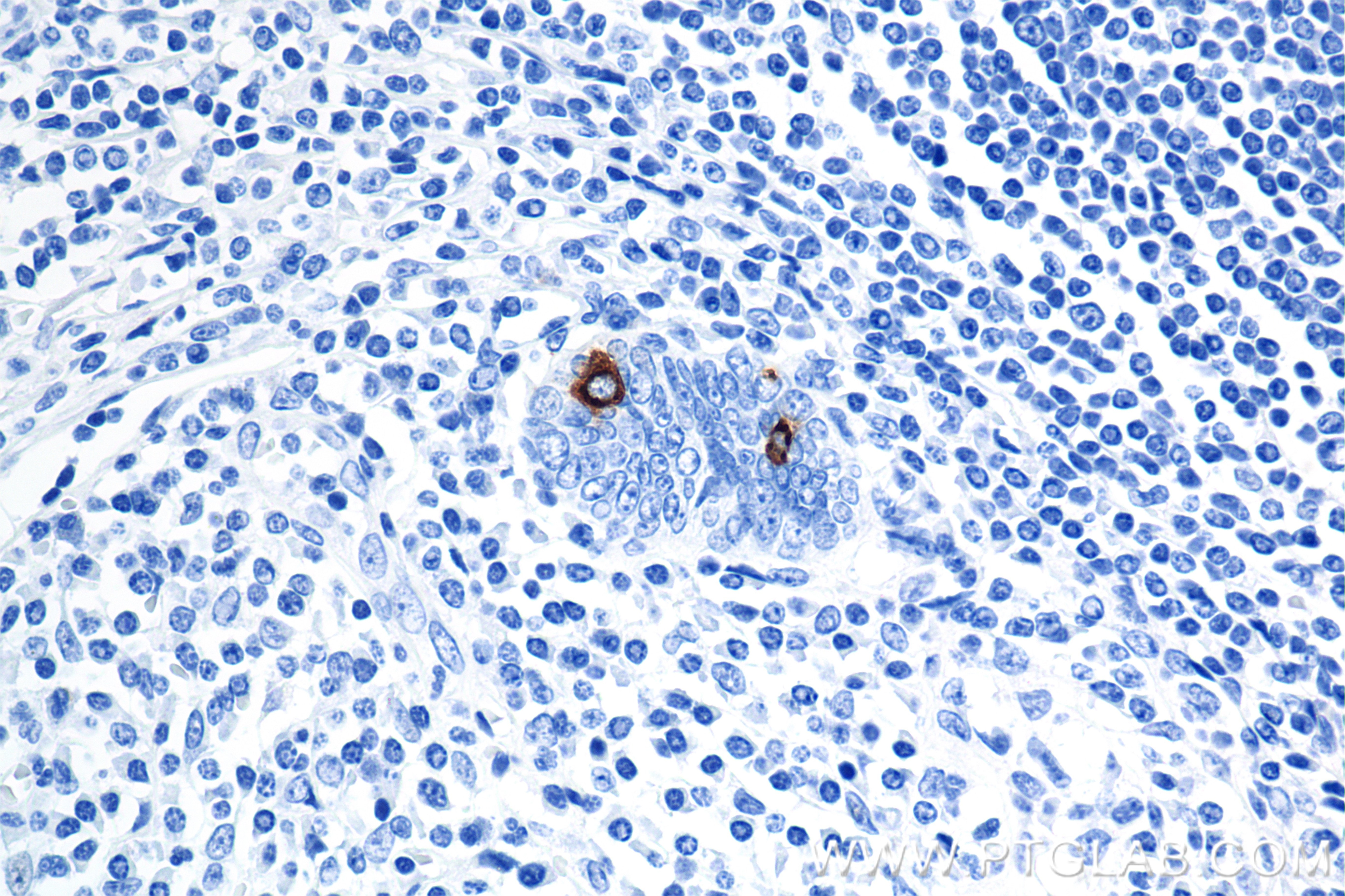 Immunohistochemistry (IHC) staining of human appendix tissue using Chromogranin A Recombinant antibody (85605-2-RR)