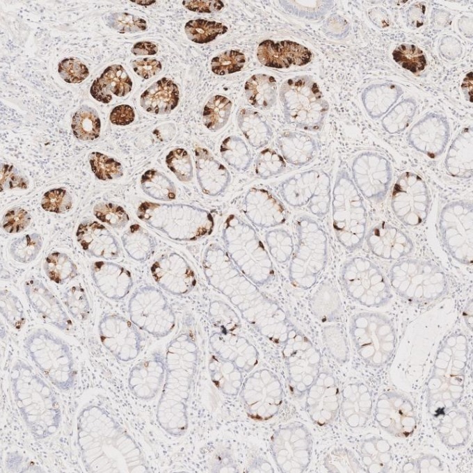 IHC staining of human stomach cancer using 85605-2-RR Immunohistochemistry (IHC) staining of human stomach cancer tissue using Chromogranin A Recombinant monoclonal antibody (85605-2-RR)