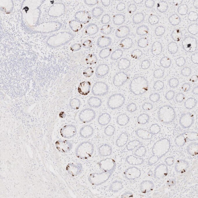 IHC staining of human colorectal cancer using 85605-2-RR Immunohistochemistry (IHC) staining of human colorectal cancer tissue using Chromogranin A Recombinant monoclonal antibody (85605-2-RR)