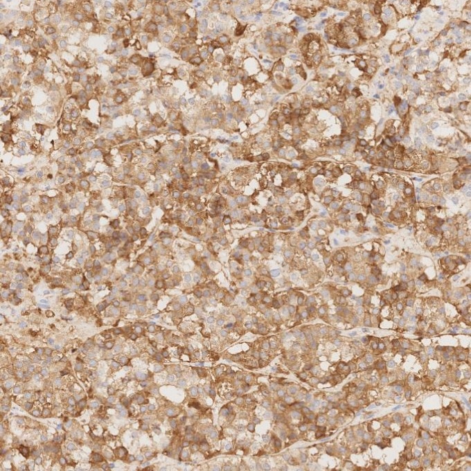 IHC staining of human pituitary adenoma using 85605-2-RR Immunohistochemistry (IHC) staining of human pituitary adenoma tissue using Chromogranin A Recombinant monoclonal antibody (85605-2-RR)