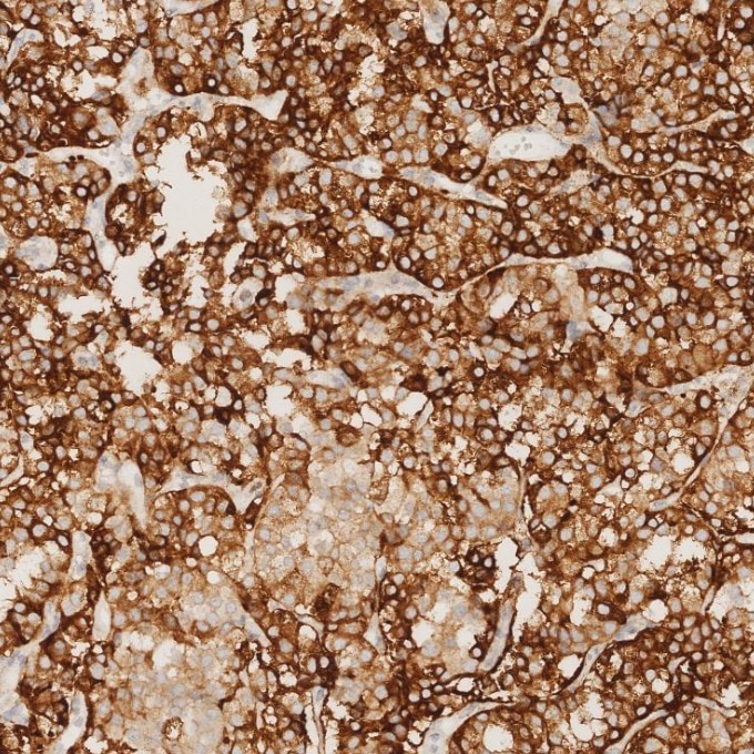 IHC staining of human pituitary adenoma using 85605-2-RR Immunohistochemistry (IHC) staining of human pituitary adenoma tissue using Chromogranin A Recombinant monoclonal antibody (85605-2-RR)