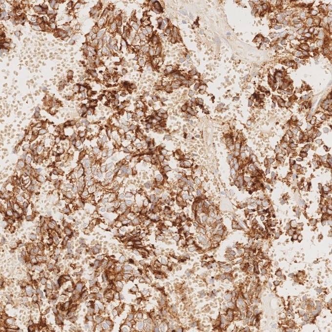 IHC staining of human pituitary adenoma using 85605-2-RR Immunohistochemistry (IHC) staining of human pituitary adenoma tissue using Chromogranin A Recombinant monoclonal antibody (85605-2-RR)