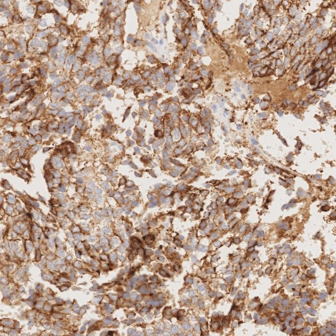 IHC staining of human pituitary adenoma using 85605-2-RR Immunohistochemistry (IHC) staining of human pituitary adenoma tissue using Chromogranin A Recombinant monoclonal antibody (85605-2-RR)