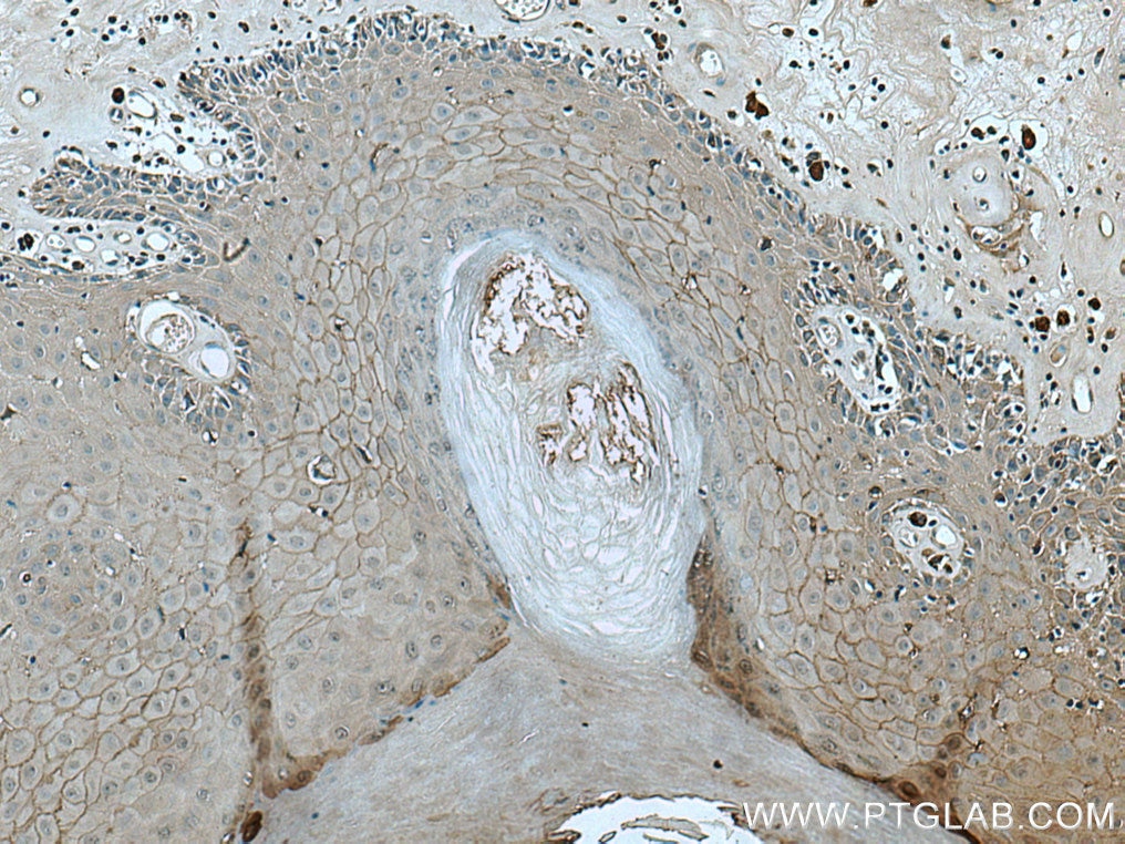 Immunohistochemistry (IHC) staining of human skin cancer tissue using Claudin 1 Polyclonal antibody (28674-1-AP)