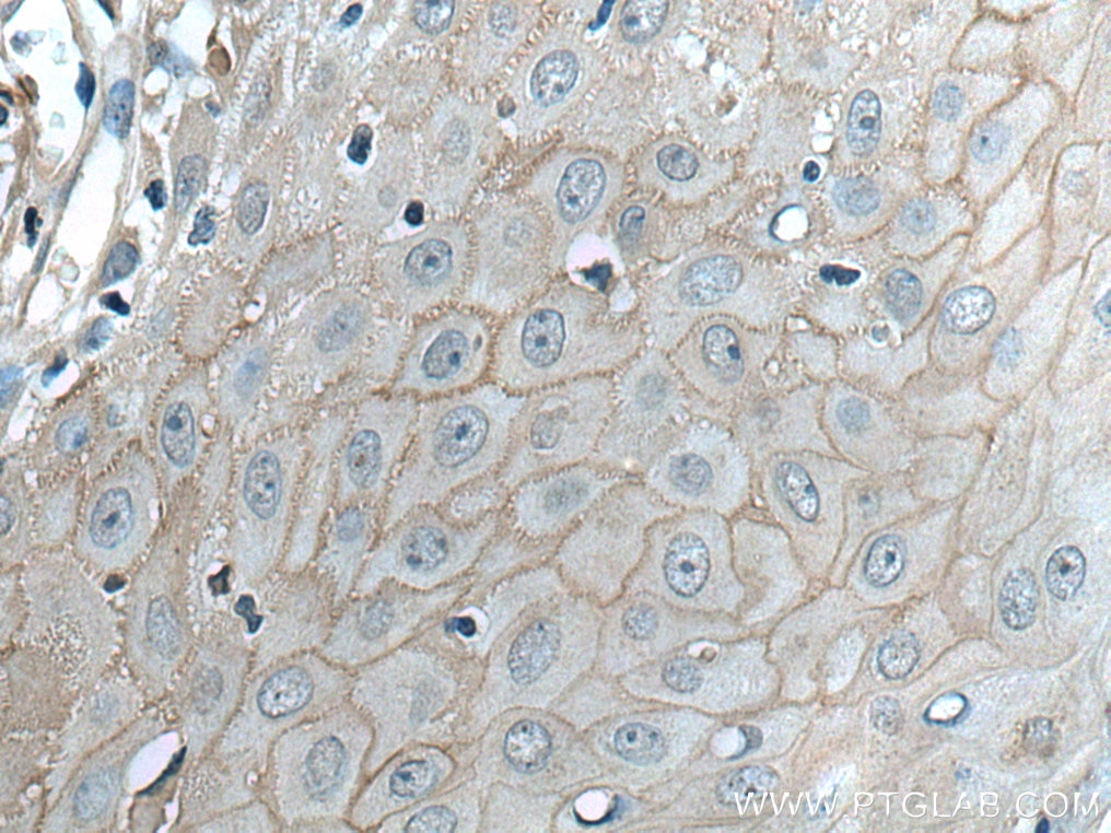 Immunohistochemistry (IHC) staining of human skin cancer tissue using Claudin 1 Polyclonal antibody (28674-1-AP)