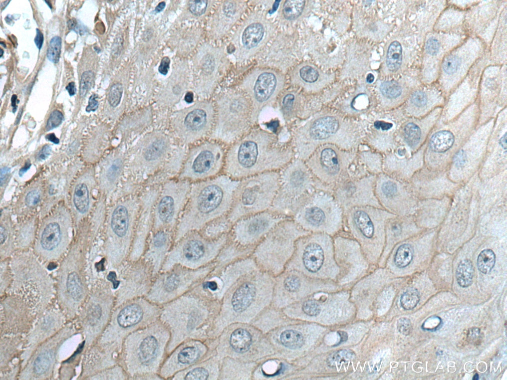 IHC staining of human skin cancer using 28674-1-AP