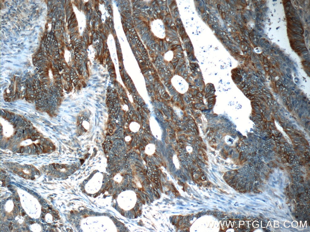 Immunohistochemistry (IHC) staining of human colon cancer tissue using Claudin 23 Polyclonal antibody (25296-1-AP)