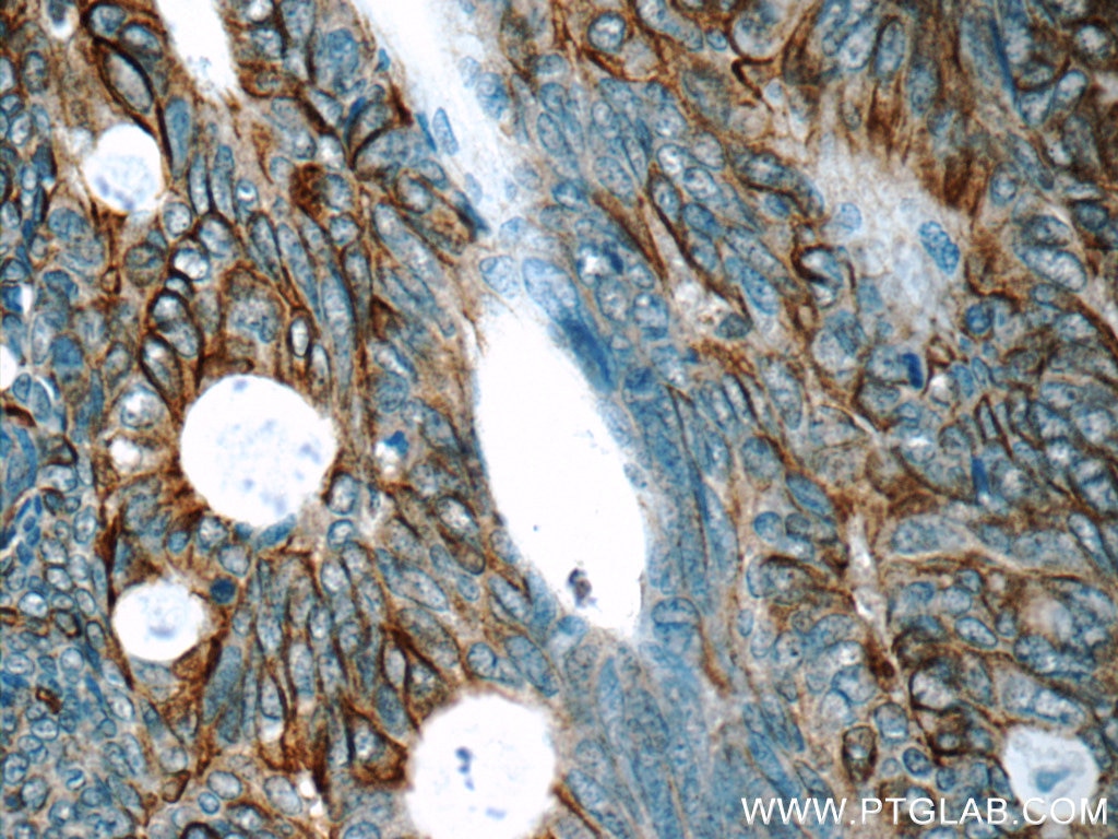 Immunohistochemistry (IHC) staining of human colon cancer tissue using Claudin 23 Polyclonal antibody (25296-1-AP)