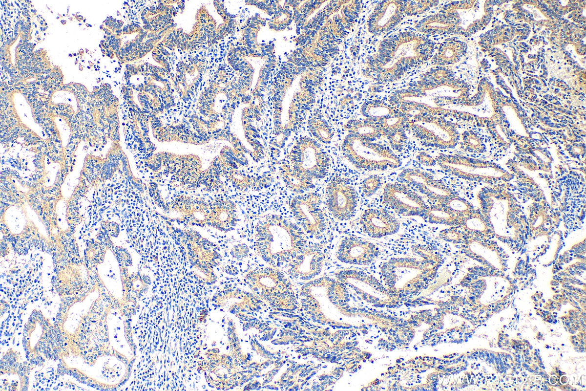 Immunohistochemistry (IHC) staining of human endometrial cancer tissue using Claudin 9 Polyclonal antibody (30520-1-AP)