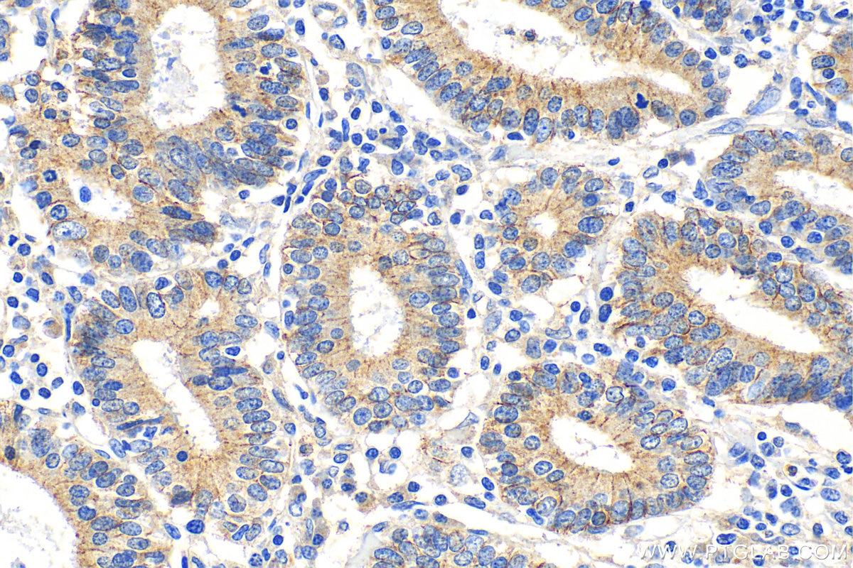 Immunohistochemistry (IHC) staining of human endometrial cancer tissue using Claudin 9 Polyclonal antibody (30520-1-AP)