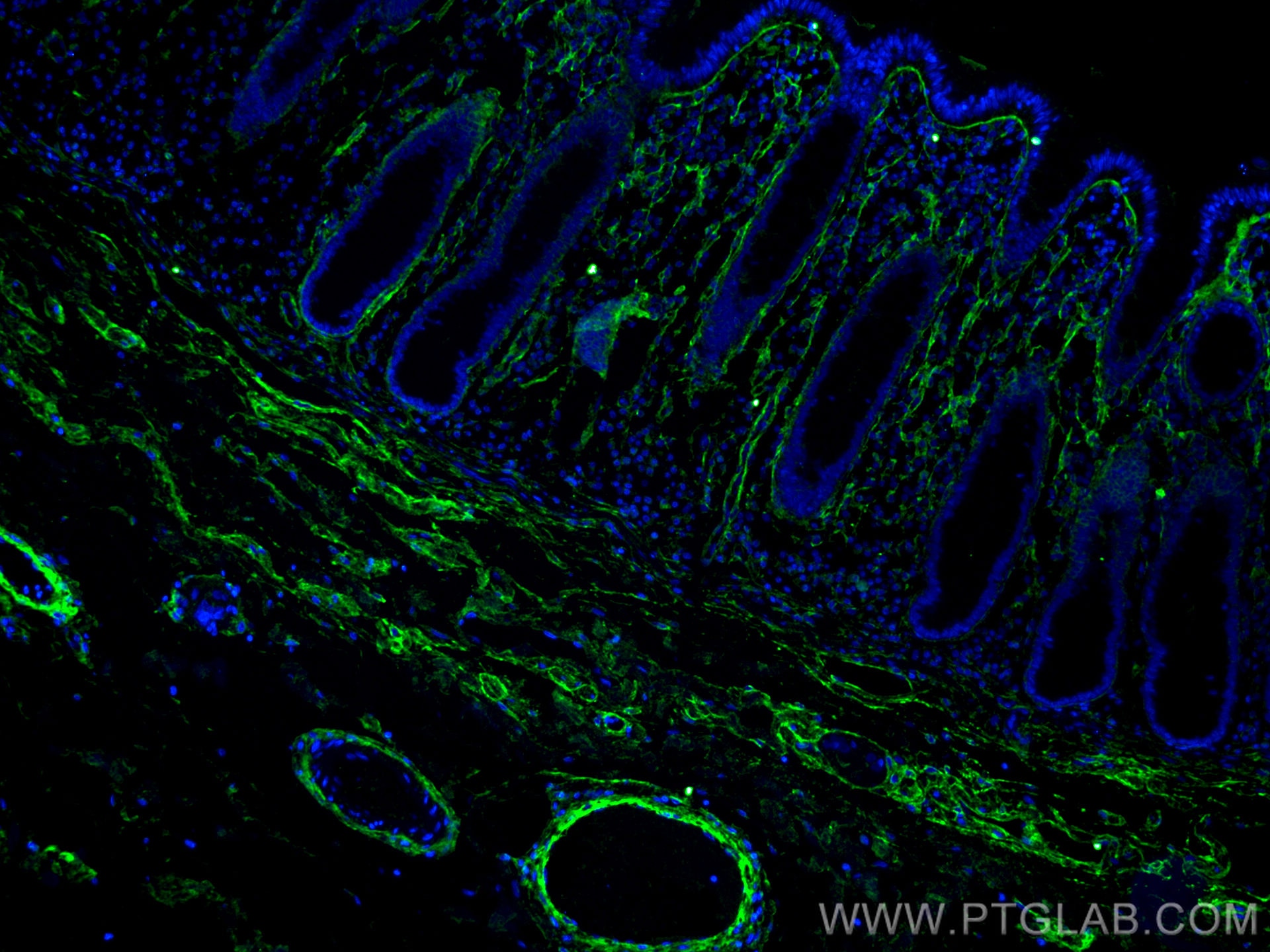 Immunofluorescence (IF) / fluorescent staining of human colon cancer tissue using Collagen Type I Monoclonal antibody (67288-1-Ig)