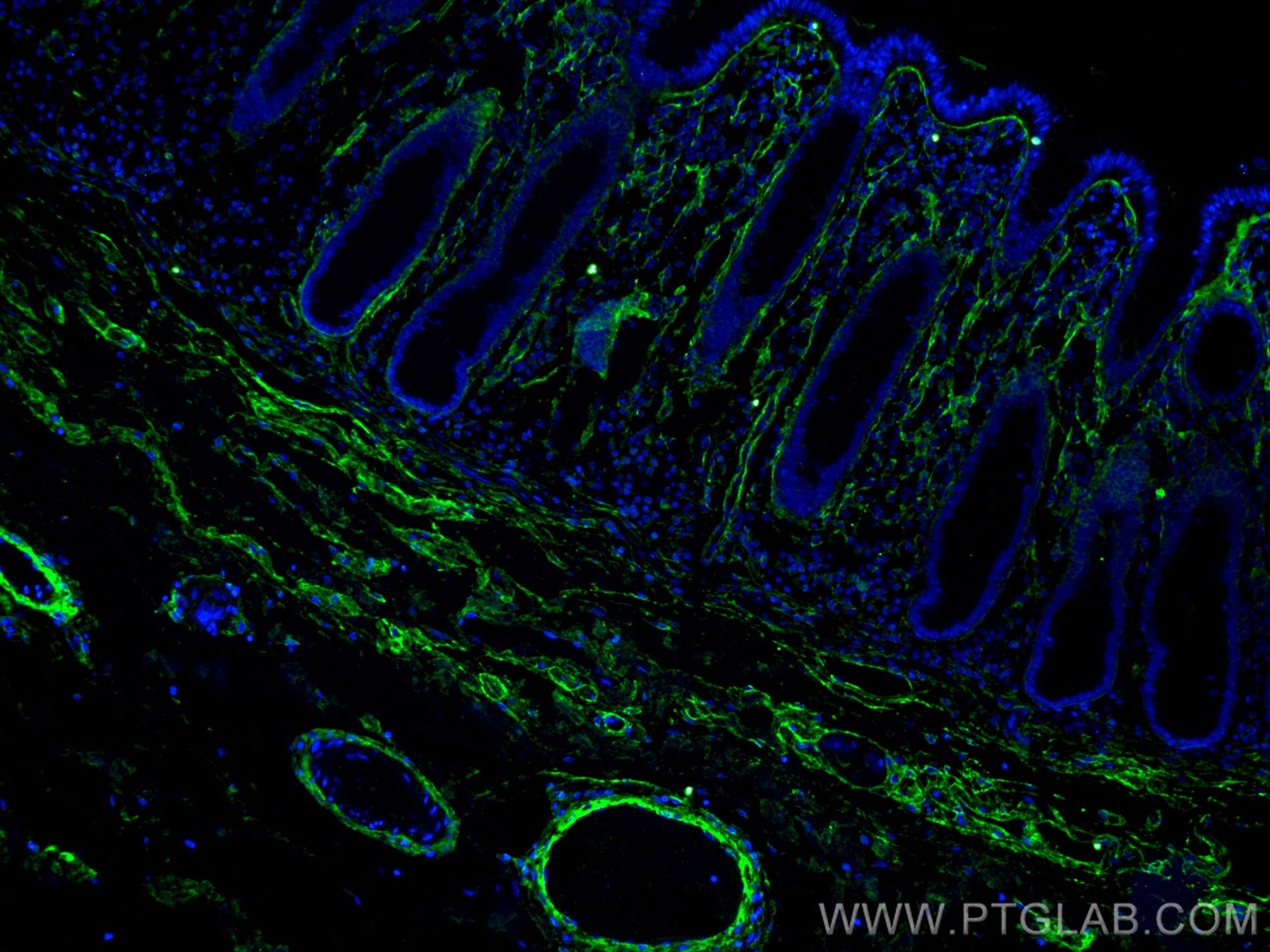 IF Staining of human colon cancer using 67288-1-Ig