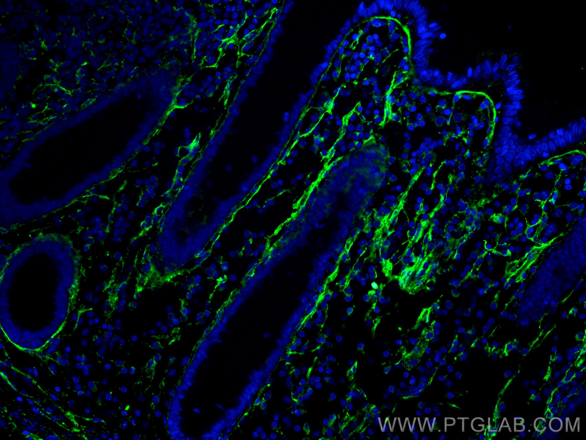 Immunofluorescence (IF) / fluorescent staining of human colon cancer tissue using Collagen Type I Monoclonal antibody (67288-1-Ig)