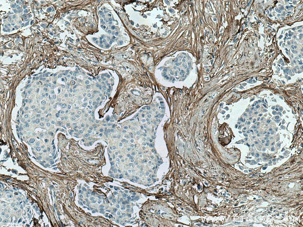 Immunohistochemistry (IHC) staining of human breast cancer tissue using Collagen Type I Monoclonal antibody (67288-1-Ig)