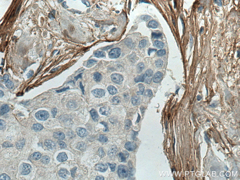 Immunohistochemistry (IHC) staining of human breast cancer tissue using Collagen Type I Monoclonal antibody (67288-1-Ig)