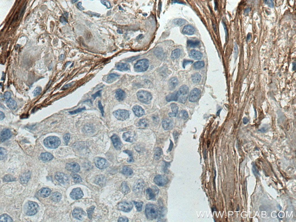 IHC staining of human breast cancer using 67288-1-Ig