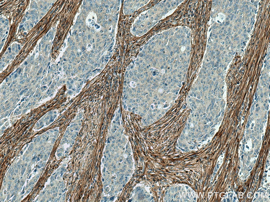 Immunohistochemistry (IHC) staining of human colon cancer tissue using Collagen Type I Monoclonal antibody (67288-1-Ig)