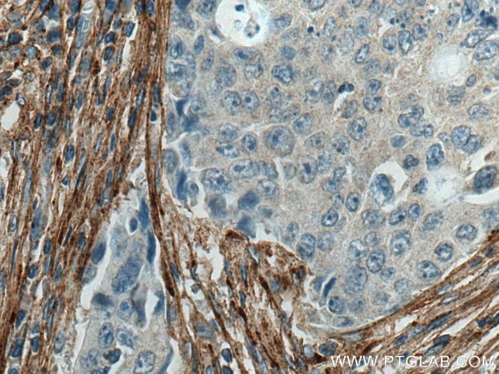 Immunohistochemistry (IHC) staining of human colon cancer tissue using Collagen Type I Monoclonal antibody (67288-1-Ig)