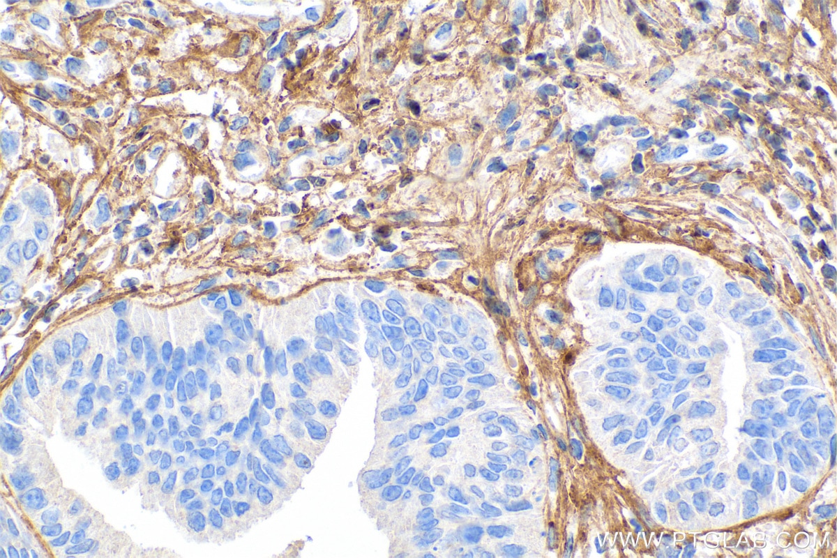 Immunohistochemistry (IHC) staining of human colon cancer tissue using Collagen Type I Monoclonal antibody (67288-1-Ig)
