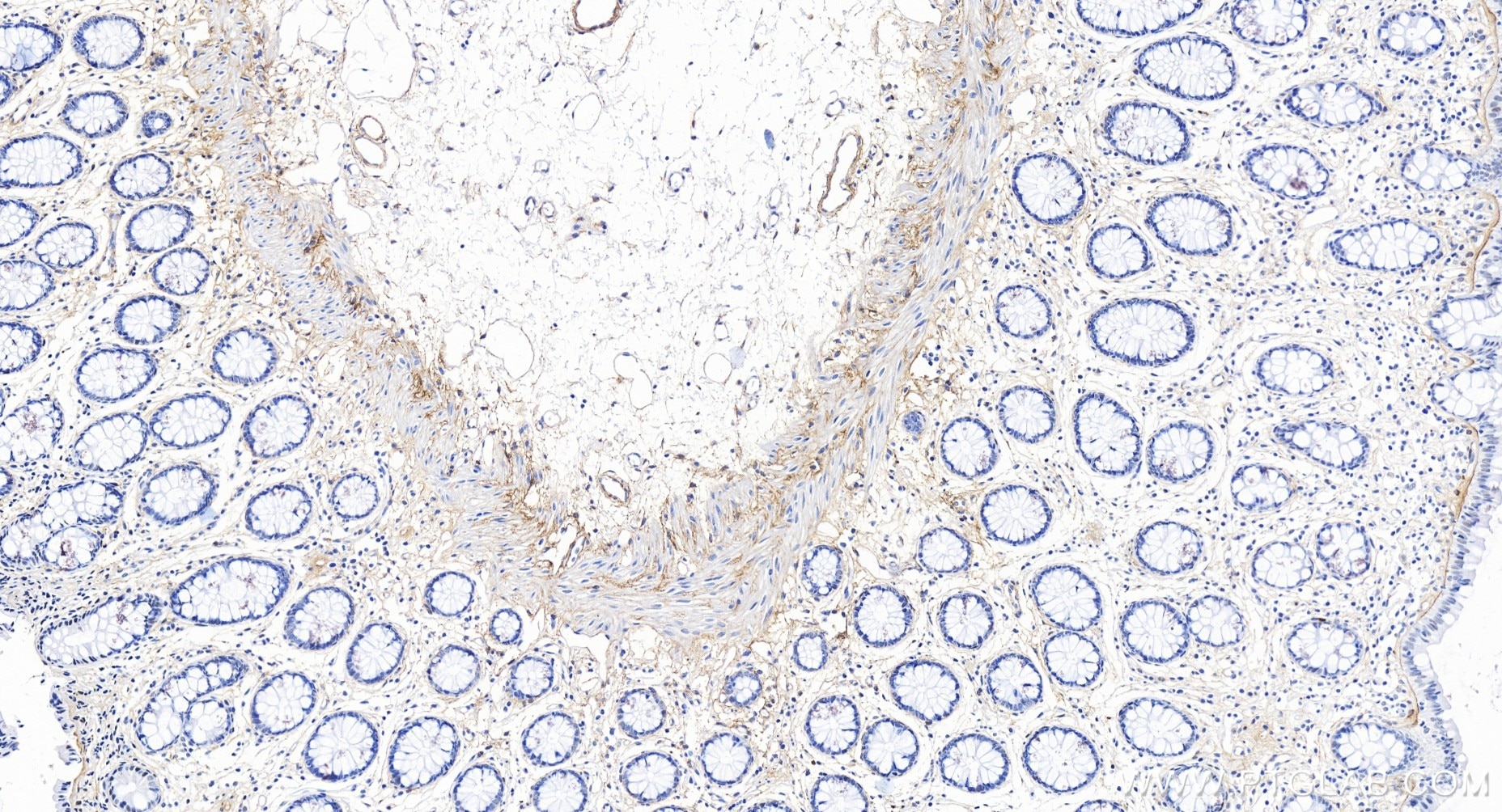 Immunohistochemistry (IHC) staining of human colon tissue using Collagen Type I Recombinant antibody (86093-1-RR)
