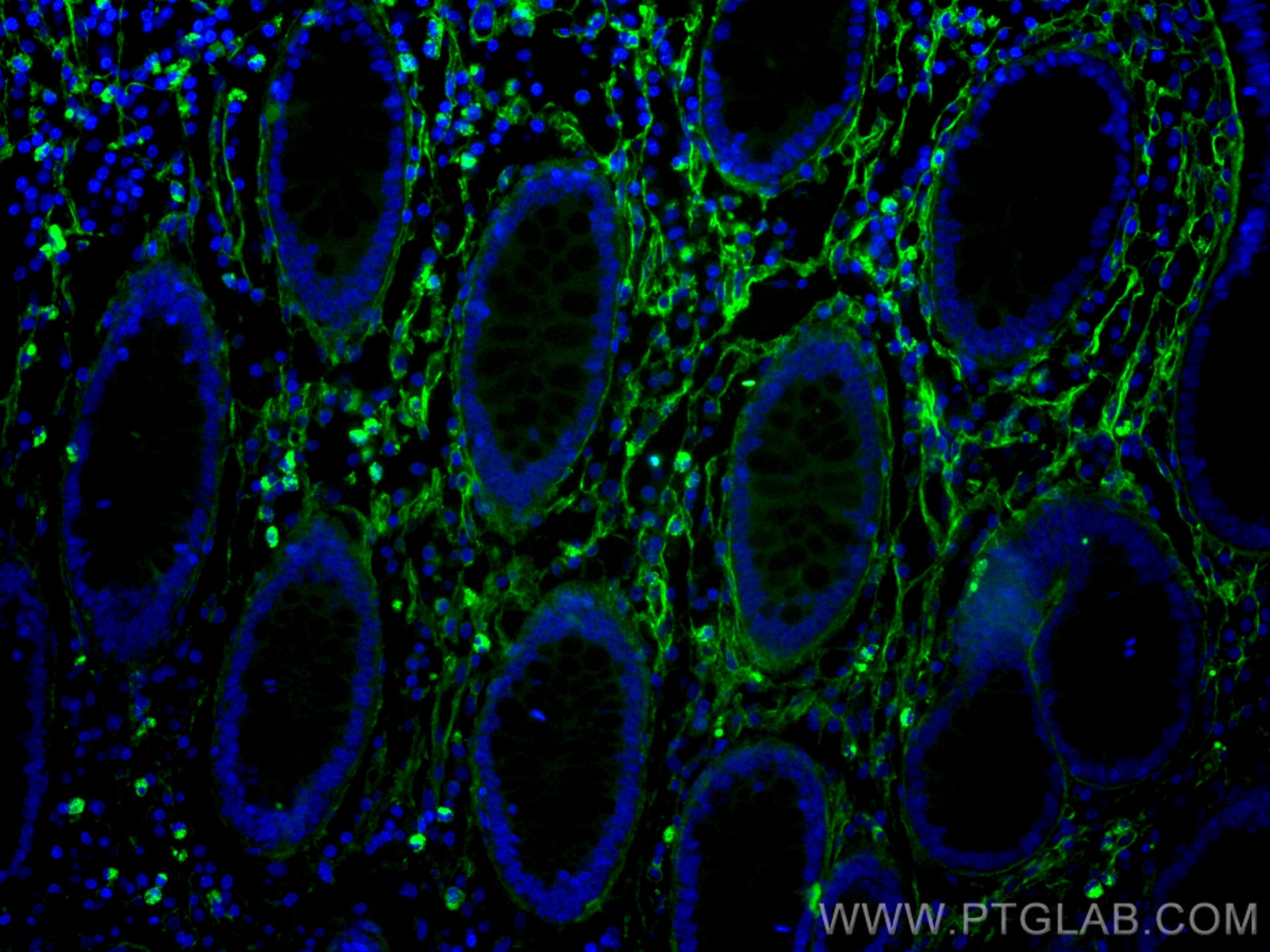 Immunofluorescence (IF) / fluorescent staining of human colon cancer tissue using CoraLite® Plus 488-conjugated Collagen Type I Mono (CL488-67288)