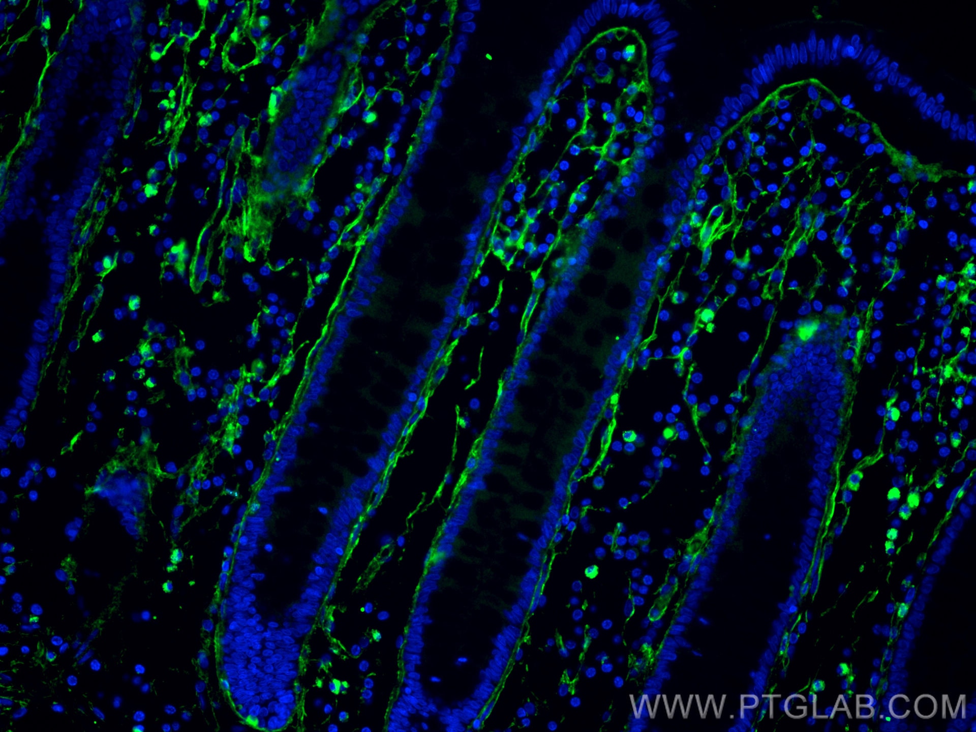 Immunofluorescence (IF) / fluorescent staining of human colon cancer tissue using CoraLite® Plus 488-conjugated Collagen Type I Mono (CL488-67288)