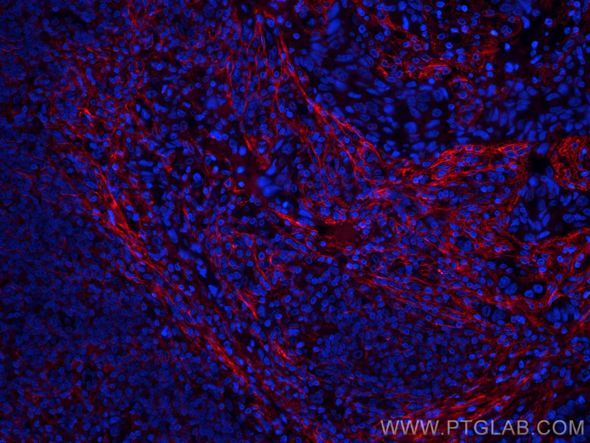 Immunofluorescence (IF) / fluorescent staining of human breast cancer tissue using CoraLite®594-conjugated Collagen Type I Monoclonal (CL594-67288)