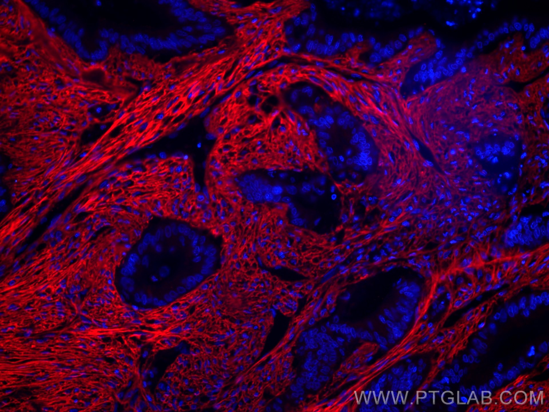 Immunofluorescence (IF) / fluorescent staining of human colon cancer tissue using CoraLite®594-conjugated Collagen Type I Monoclonal (CL594-67288)