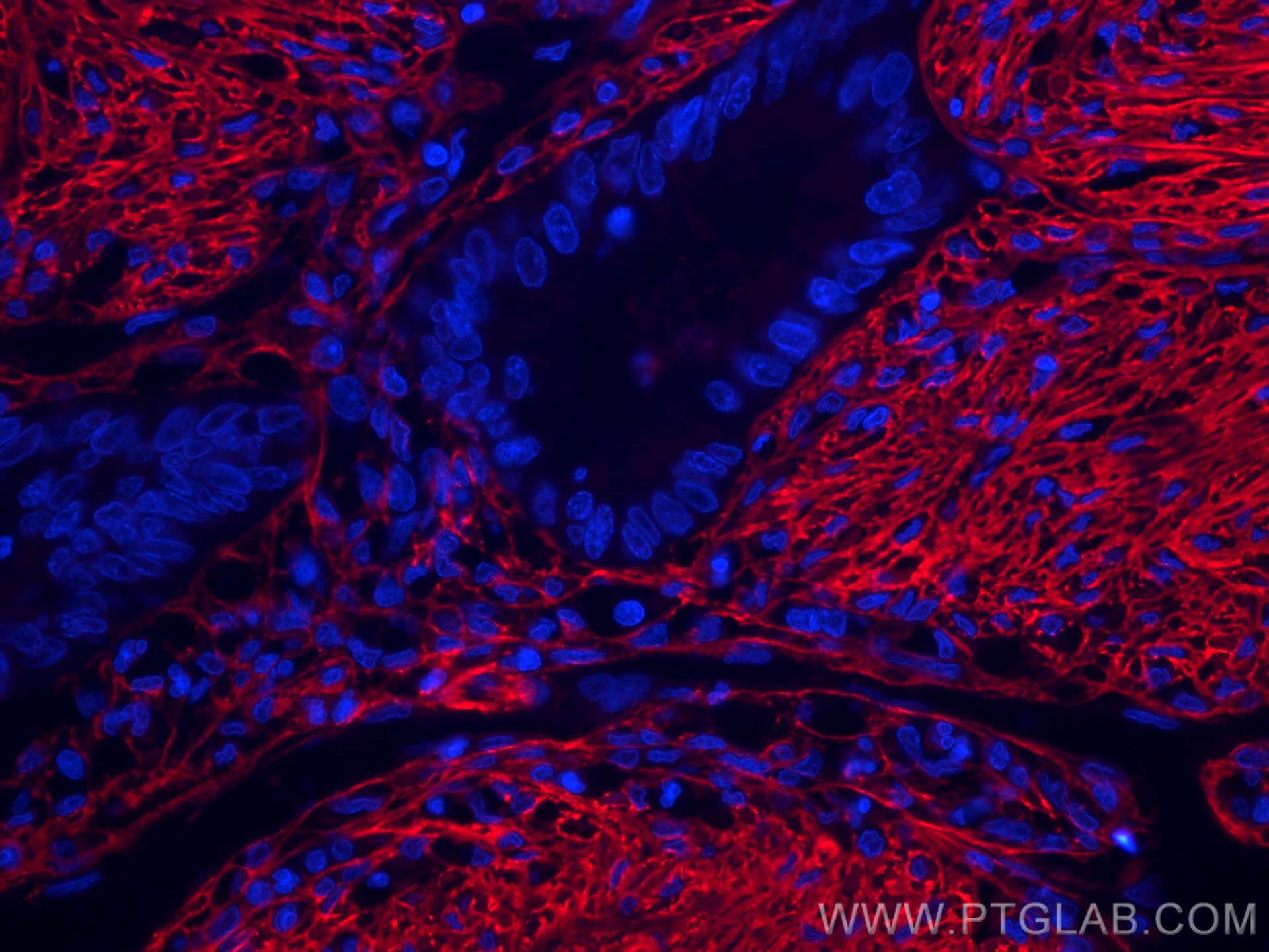 Immunofluorescence (IF) / fluorescent staining of human colon cancer tissue using CoraLite®594-conjugated Collagen Type I Monoclonal (CL594-67288)