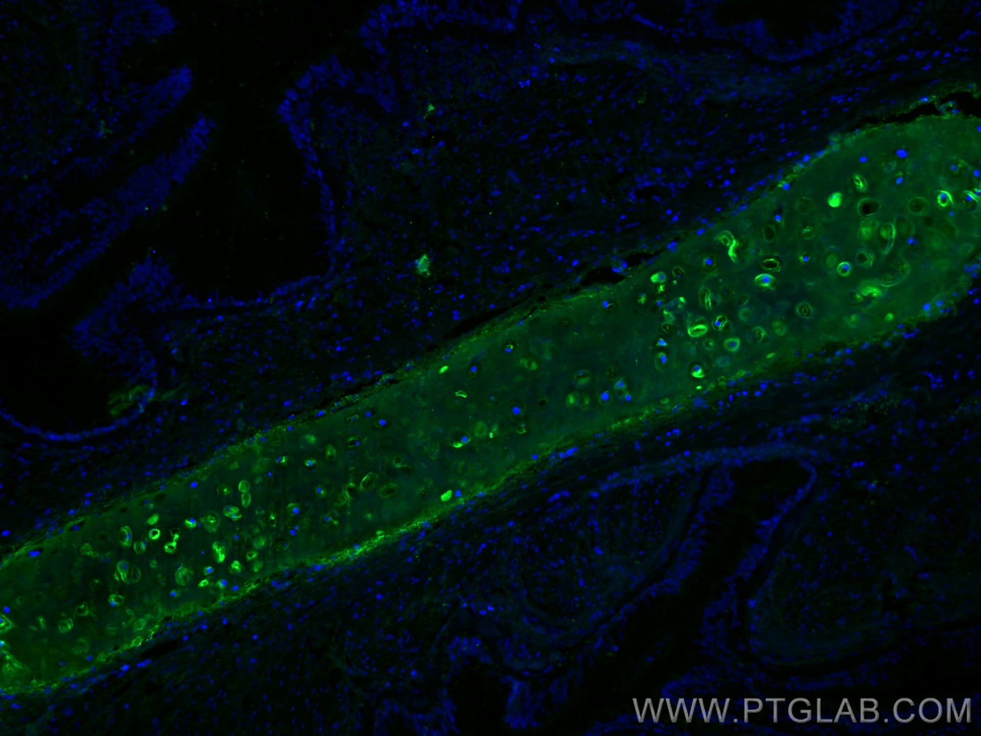 IF Staining of human lung cancer using 28459-1-AP