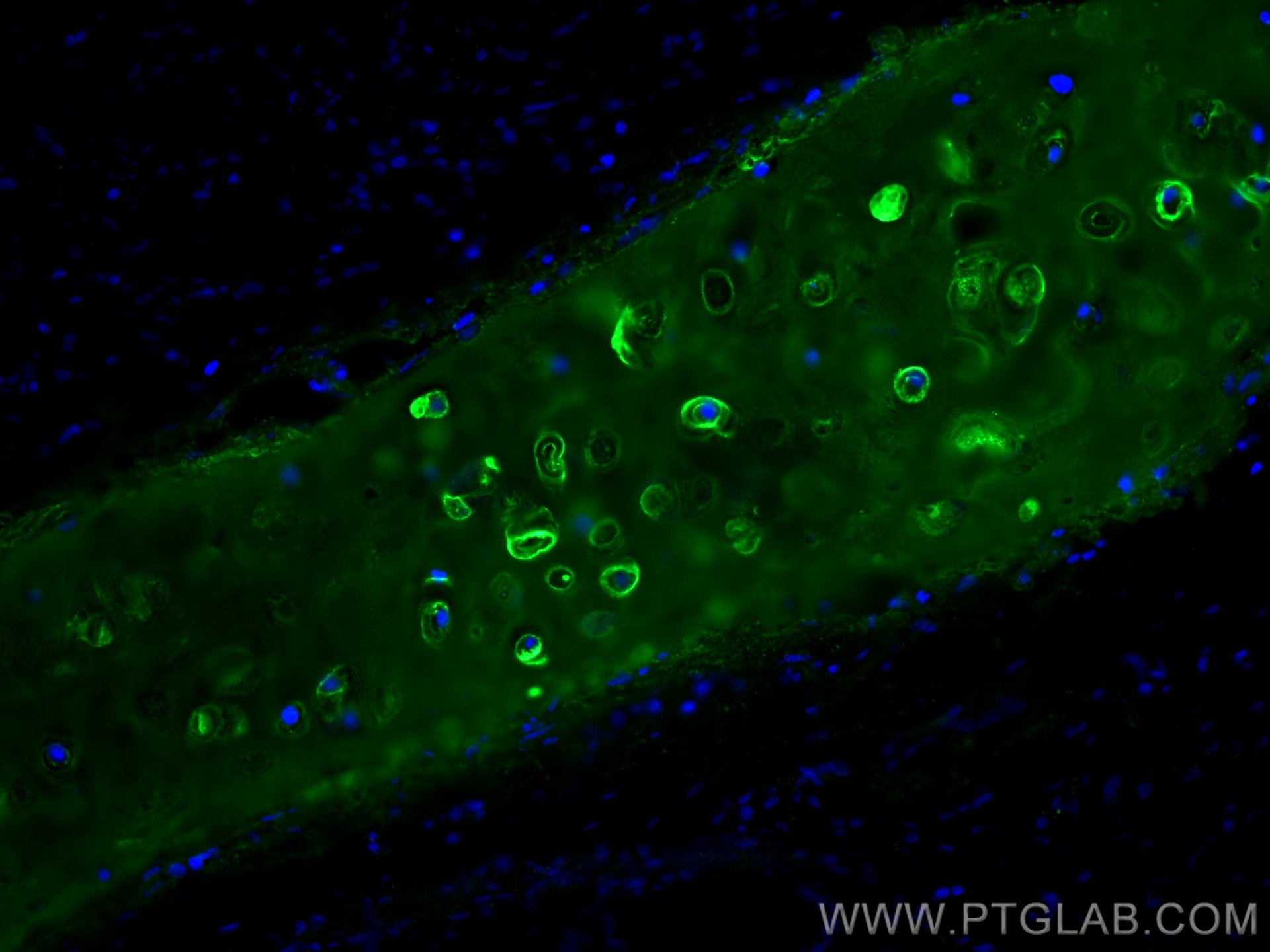Immunofluorescence (IF) / fluorescent staining of human lung cancer tissue using Collagen Type II Polyclonal antibody (28459-1-AP)