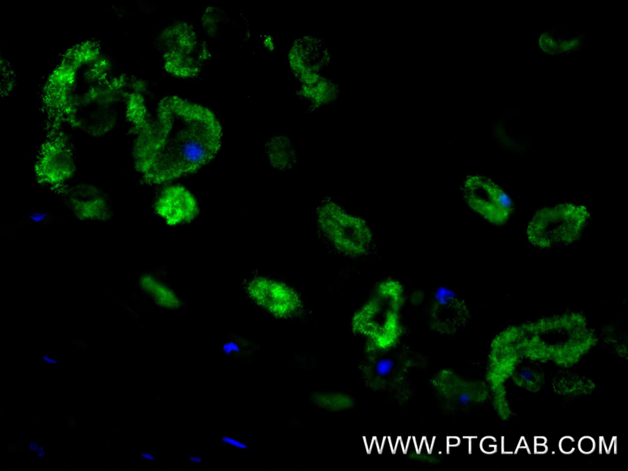 Immunofluorescence (IF) / fluorescent staining of human lung cancer tissue using Collagen Type II Recombinant monoclonal antibody (86139-2-RR)