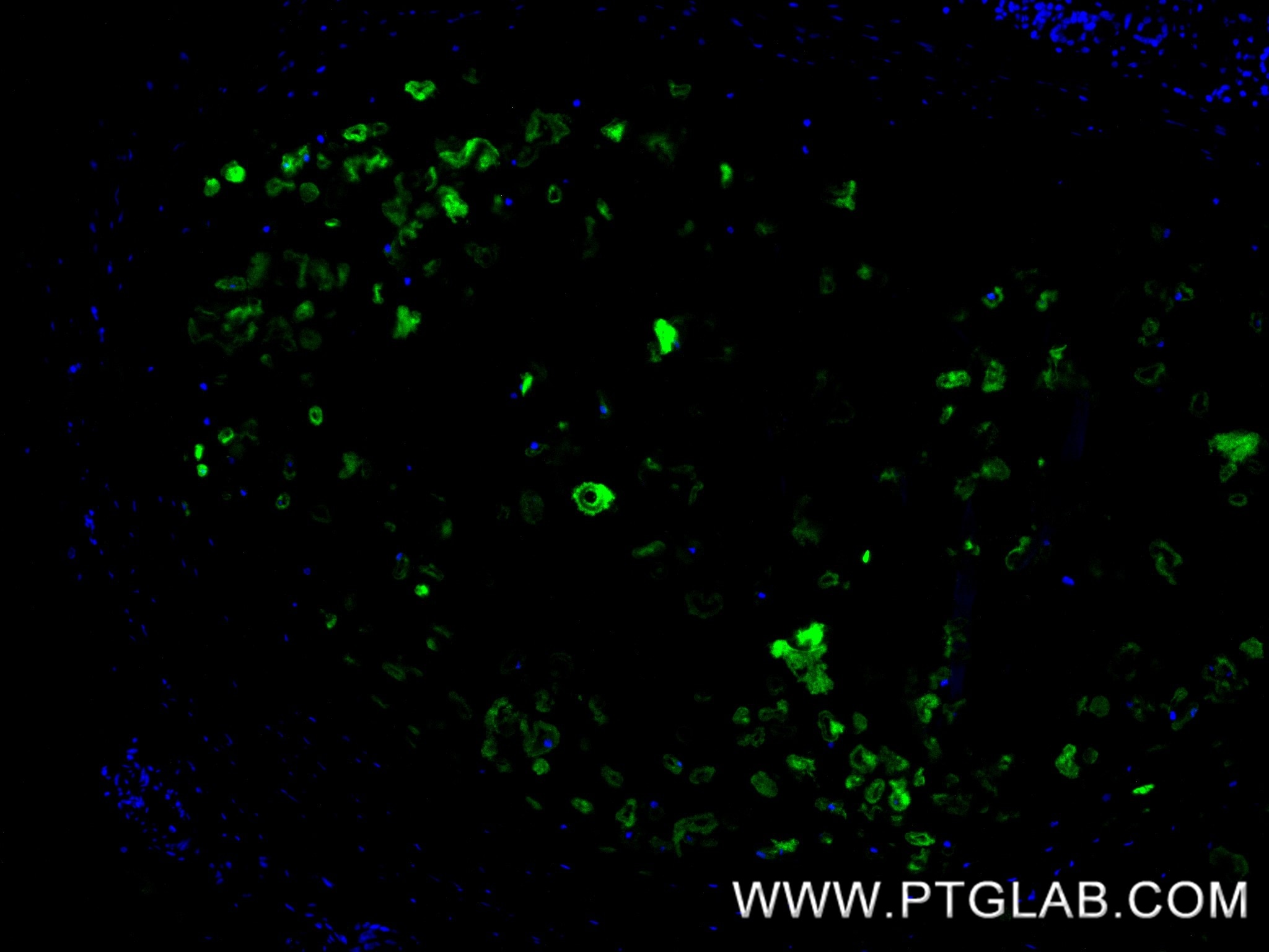Immunofluorescence (IF) / fluorescent staining of human lung cancer tissue using Collagen Type II Recombinant monoclonal antibody (86139-2-RR)