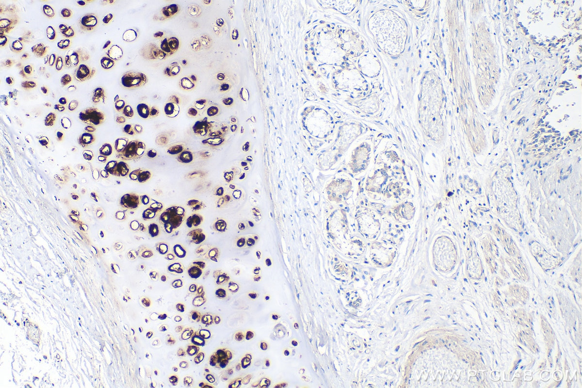Immunohistochemistry (IHC) staining of human lung cancer tissue using Collagen Type II Recombinant monoclonal antibody (86139-2-RR)