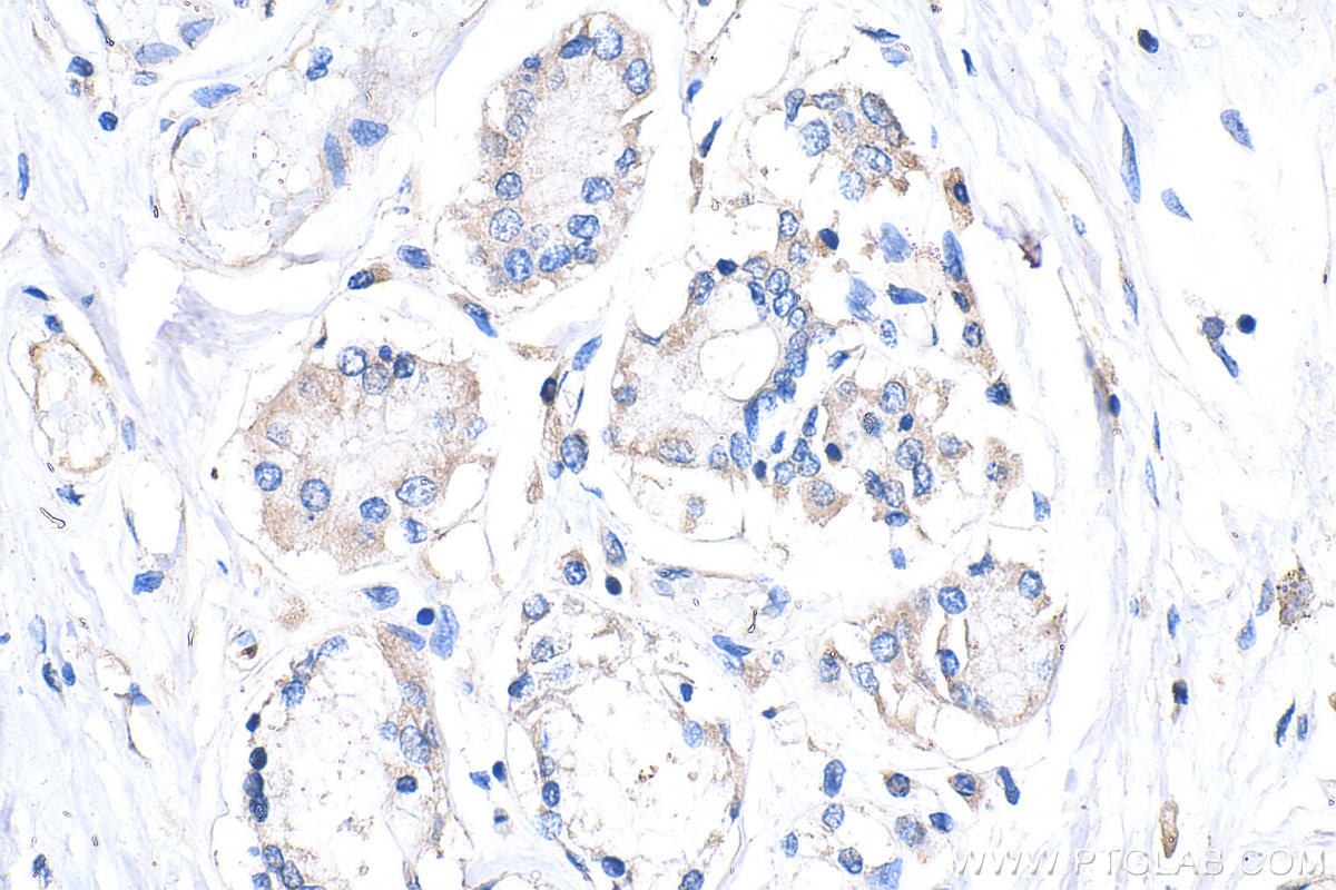 Immunohistochemistry (IHC) staining of human lung cancer tissue using Collagen Type II Recombinant monoclonal antibody (86139-2-RR)