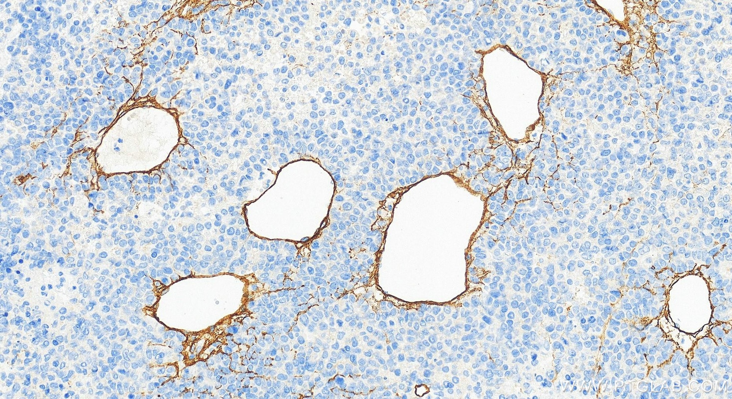 Immunohistochemistry (IHC) staining of Hepatocellular carcinoma tissue using COL4A1 Polyclonal antibody (30850-1-AP)