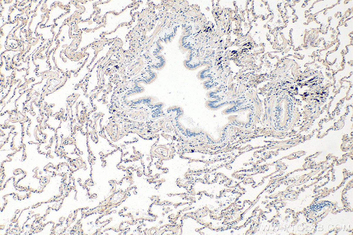 Immunohistochemistry (IHC) staining of human lung cancer tissue using Collagen Type IV Polyclonal antibody (30850-1-AP)