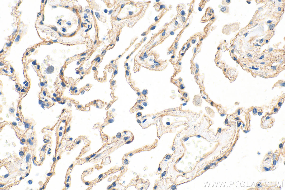 Immunohistochemistry (IHC) staining of human lung cancer tissue using Collagen Type IV Polyclonal antibody (30850-1-AP)