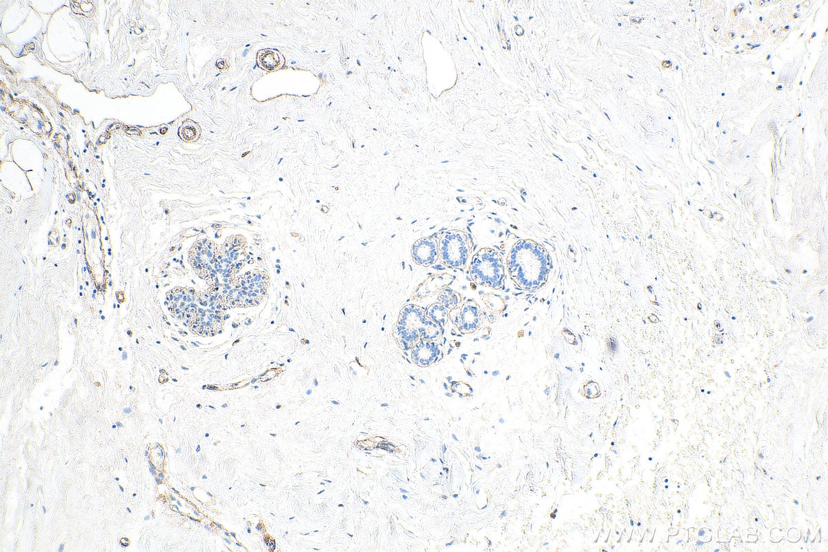 Immunohistochemistry (IHC) staining of human breast cancer tissue using COL4A2-specific Polyclonal antibody (55131-1-AP)