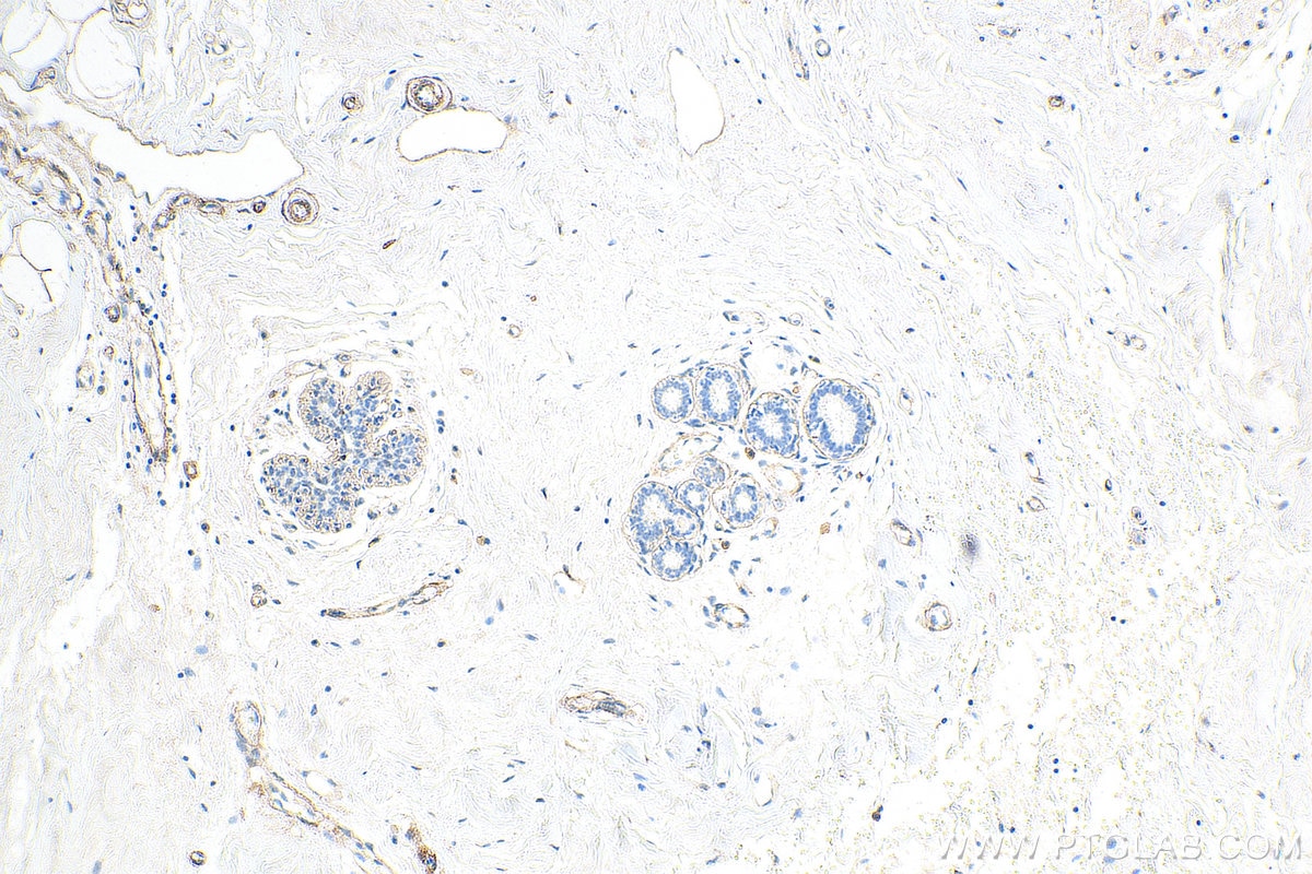 IHC staining of human breast cancer using 55131-1-AP