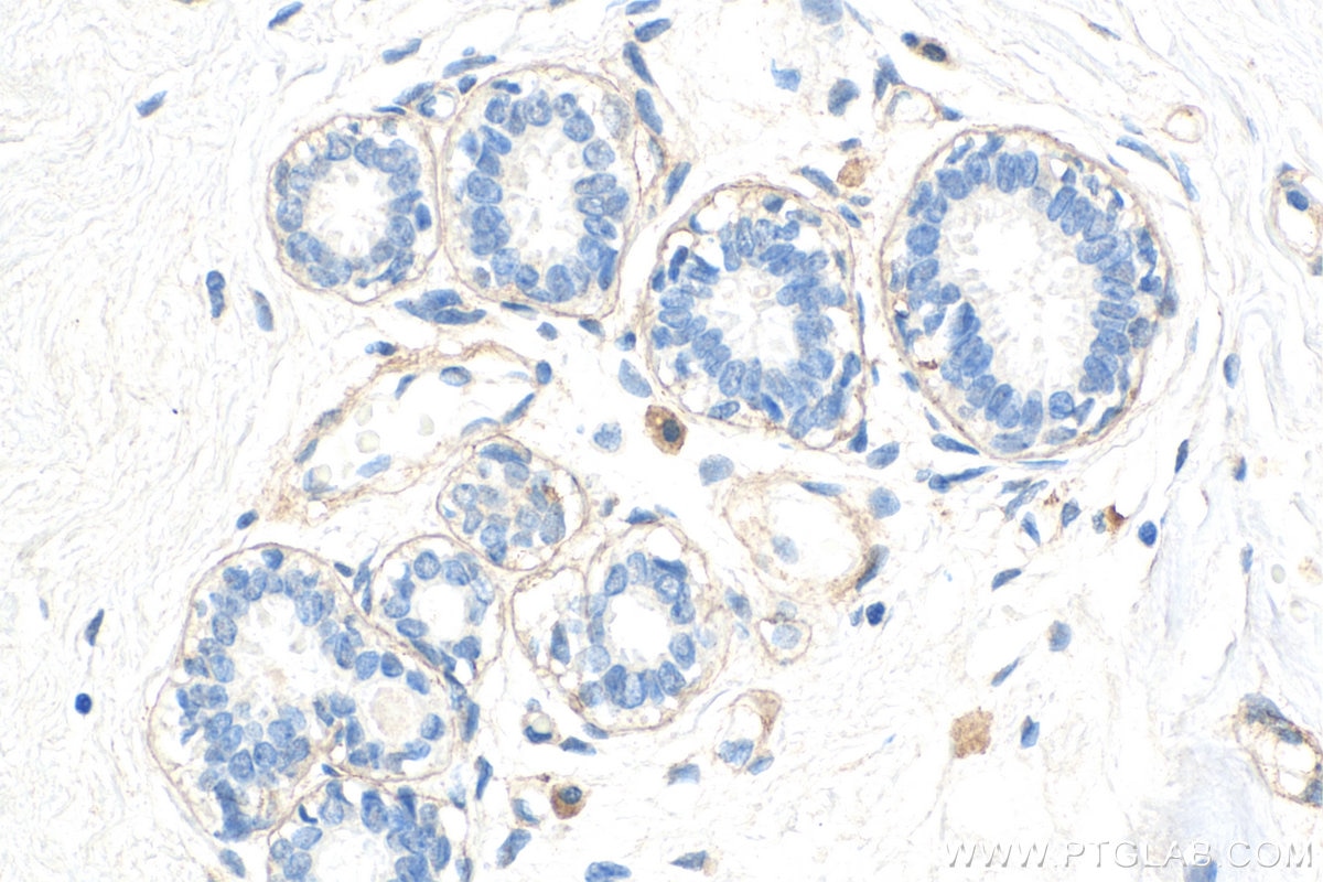 IHC staining of human breast cancer using 55131-1-AP