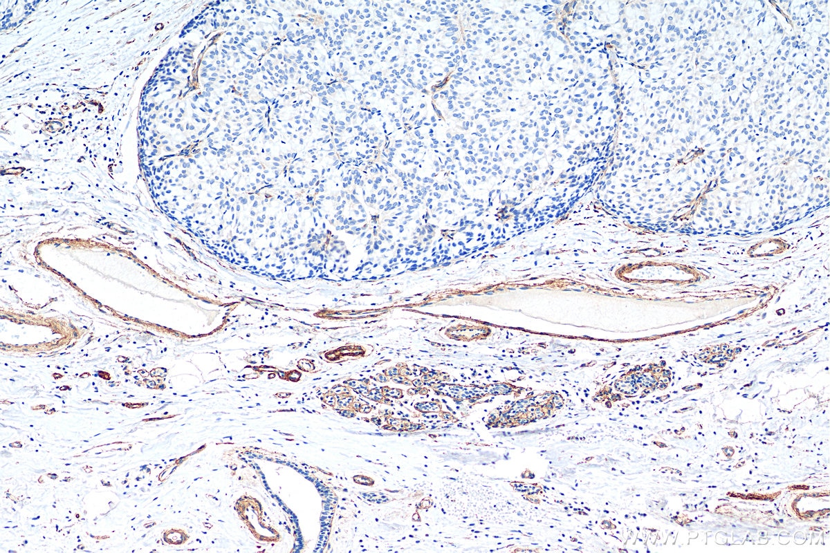 Immunohistochemistry (IHC) staining of human breast hyperplasia tissue using COL4A2-specific Polyclonal antibody (55131-1-AP)