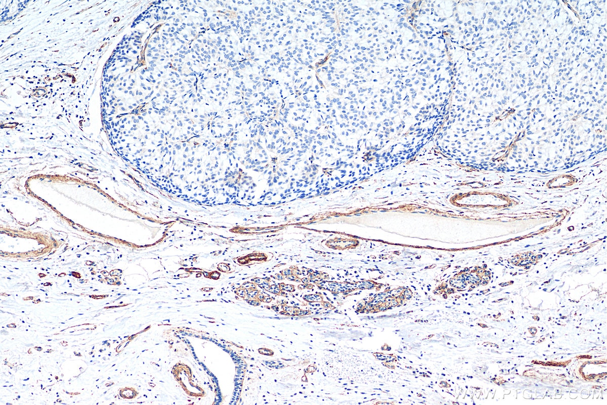 IHC staining of human breast hyperplasia using 55131-1-AP