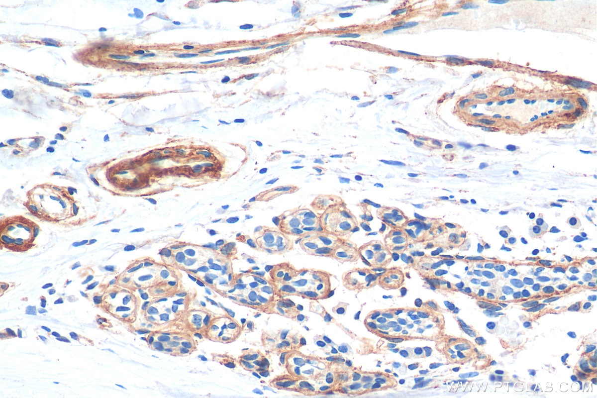 Immunohistochemistry (IHC) staining of human breast hyperplasia tissue using COL4A2-specific Polyclonal antibody (55131-1-AP)