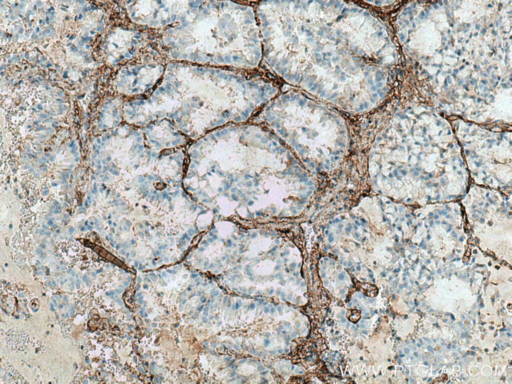 IHC staining of human lung cancer using 28382-1-AP
