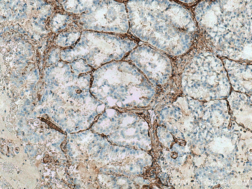 Immunohistochemistry (IHC) staining of human lung cancer tissue using Collagen Type V Polyclonal antibody (28382-1-AP)