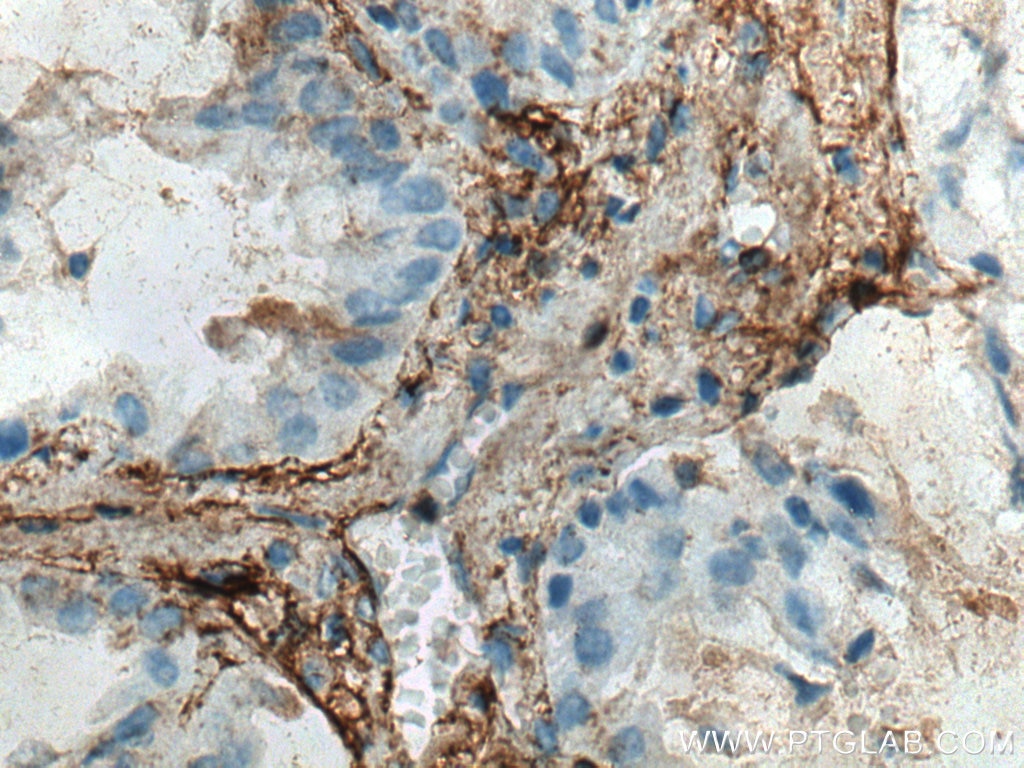 Immunohistochemistry (IHC) staining of human lung cancer tissue using Collagen Type V Polyclonal antibody (28382-1-AP)